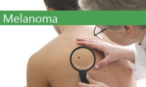 science melanoma viagra